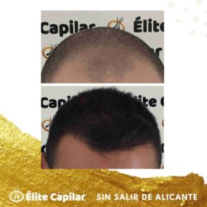 injerto capilar