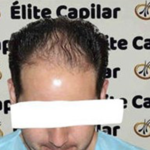 Paciente 2 antes del injerto capilar en Élite Capilar Benidorm