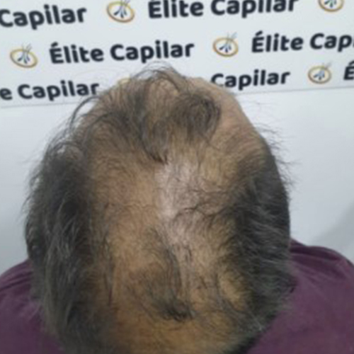 Paciente 4 antes del injerto capilar en Élite Capilar Benidorm