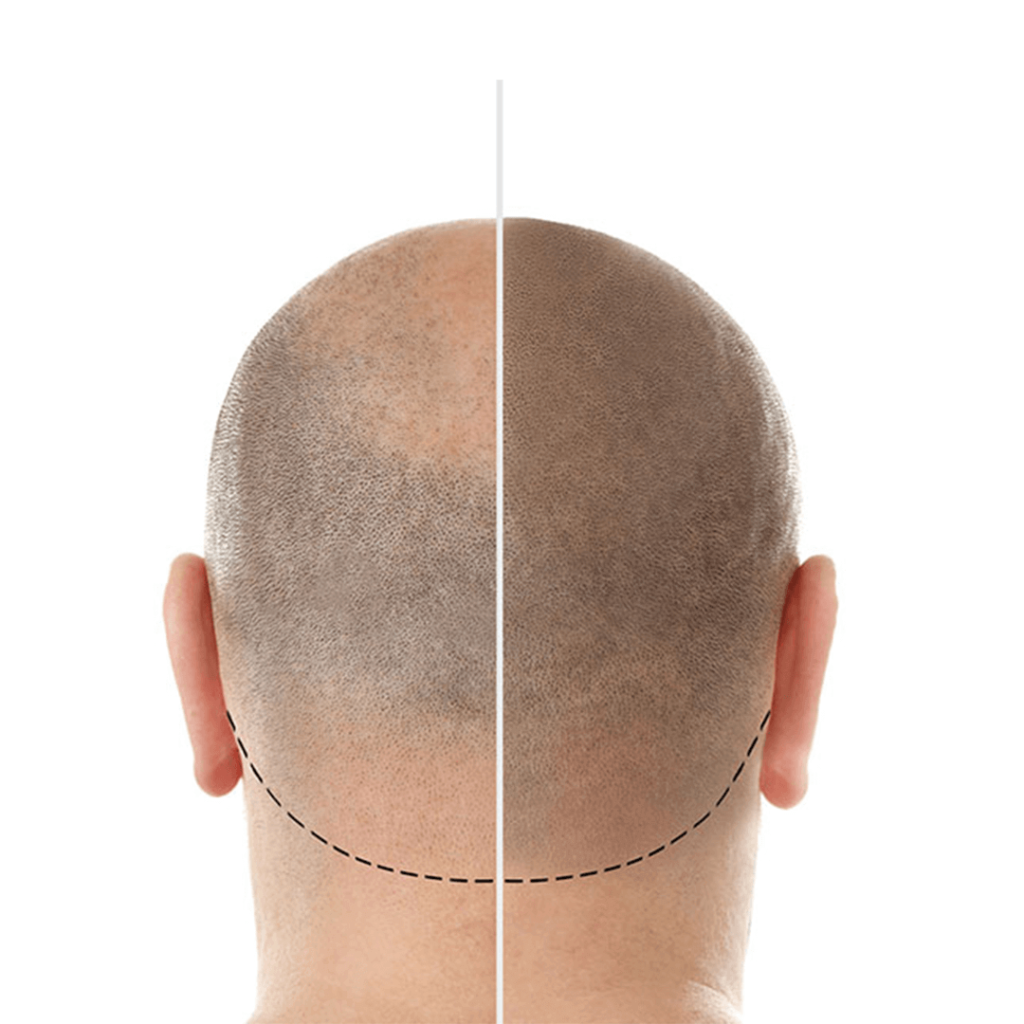Imagen que muestra el antes y después de la micropigmentacion capilar como tratamiento para disimular entradas y calvicie