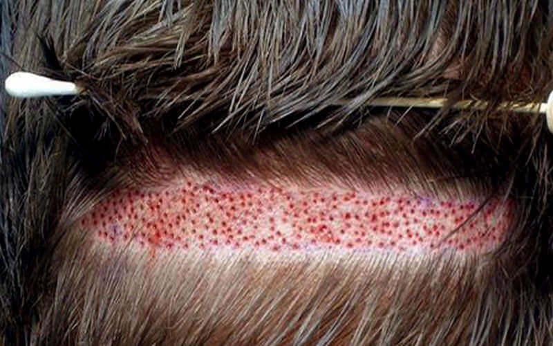 Imagen que muestra la extracción de la tira de cabello para la técnica FUT