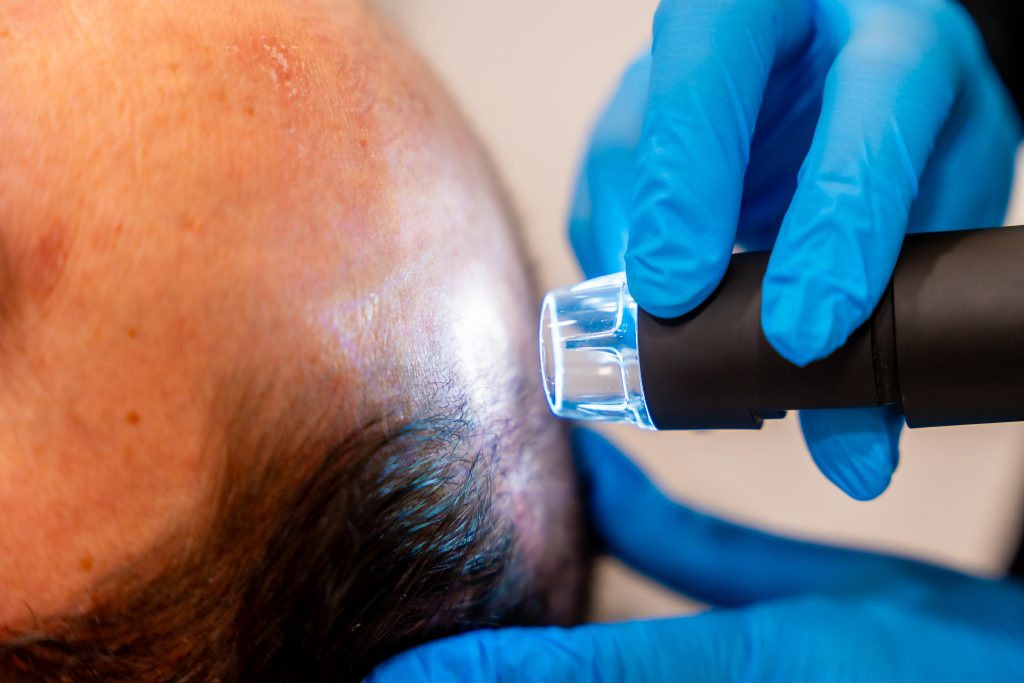 implantación capilar