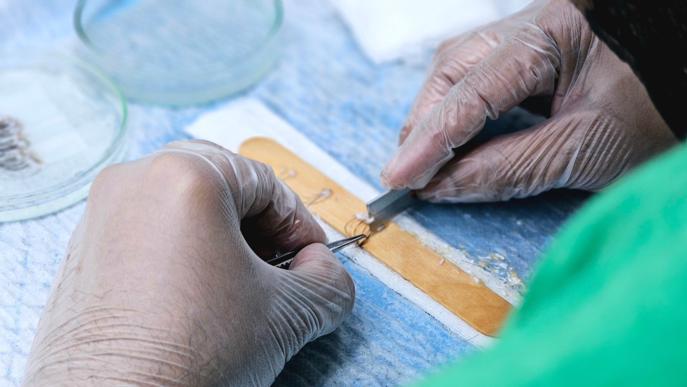 Manos con guantes preparando los injertos capilares antes de implantarlos
