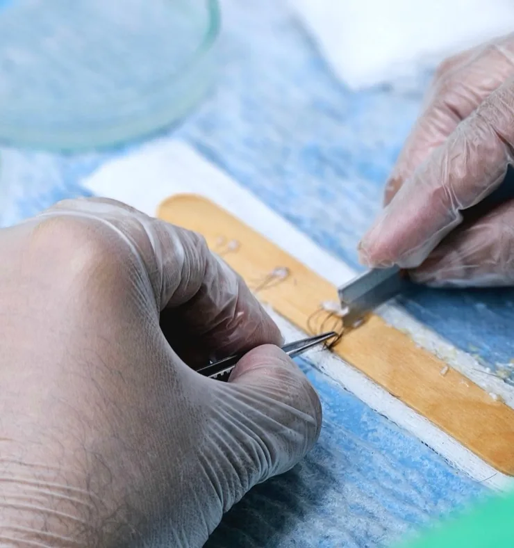 Preparación de injertos capilares en el quirófano de Élite Capilar